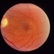 Type II Idiopathic Bilateral Juxtafoveolar Retinal Telangiectasis