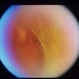 Asteroid Hyalosis Asteroid Hyalosis