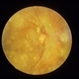 Asteroid Hyalosis Asteroid Hyalosis