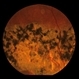 Central Areolar Choroidal Sclerosis