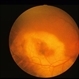Macroaneurysm Macroaneurysm