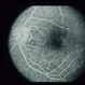 Type II Idiopathic Bilateral Juxtafoveolar Retinal Telangiectasis