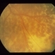 Intraocular Inflammation