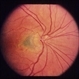 Peripapillary, ARMD Peripapillary, ARMD