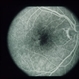 Type II Idiopathic Bilateral Juxtafoveolar Retinal Telangiectasis
