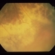 Intraocular Inflammation