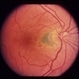 Peripapillary CNV  in ARMD Peripapillary CNV  in ARMD