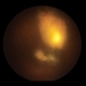 Toxo Chorioretinitis