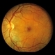 Solar Retinopathy Solar Retinopathy