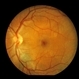 Solar Retinopathy Solar Retinopathy
