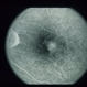 Type II Idiopathic Bilateral Juxtafoveolar Retinal Telangiectasis