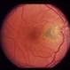 Peripapillary CNV in ARMD Peripapillary CNV in ARMD