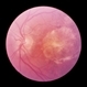 Ocular Histoplasmosis With Macular Changes