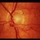 Multiple Retinal Arterial Macroaneurysms