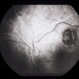 Subretinal Hemorrhage With Exudative Detachment