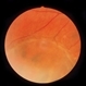 Retinoschisis Secondary To Pars Planitis