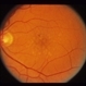 Small Macular Hemorrhage