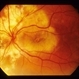Decreased Central Vision