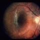 Gyrate Atrophy