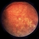 Vasculitis With Neovascularization