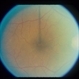 Non-Specific Old Chorioretinetic Scars