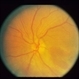Severe Commotio Retinae With Edema And Hemorrhages