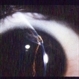 Corneal Laceration Iris In Wound