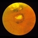 Toxoplasmosis Scar