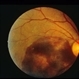 Central Visual Acuity Loss