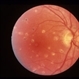 Avulsion of the Optic Nerve OD