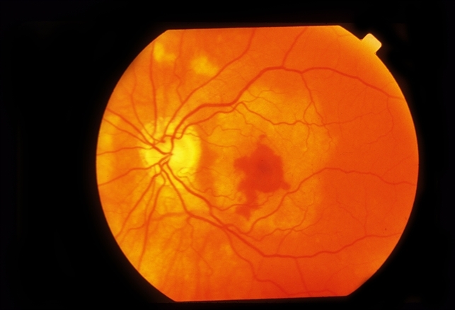 Choroidal Neovascularization - Retina Image Bank