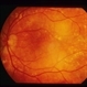 Sudden Vision Loss