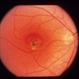 Idiopathic Choroidal Neovasculization (CNV)
