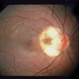 Retinoblastoma To Chemothermotherapy