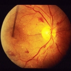 Hypertensive Retinopathy - Retina Image Bank