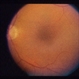 Cystoid Macular Edema (CME)