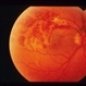 Blurring Of Central And Inferior Visual Field