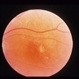 Superior Paracentral Scotoma