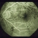 Idiopathic Polypoidal Choroidal Vasculopathy