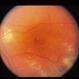 Retinal Telangiectasia