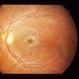 Stellate Maculopathy
