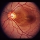 Bilateral Serous Detachments
