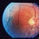 Retinal Detachment Of The Macula