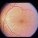 Bilateral Decreased Vision