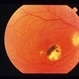 Ocular Histoplasmosis Syndrome (OHS)