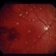 Decreased Visual Acuity (Case 2)