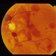 SubArachnoid Hemorrhage - Retina Image Bank