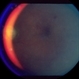 Retinal Vascular Occlusive Disease