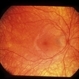 Uveitis