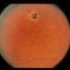 Intraocular Inflammation